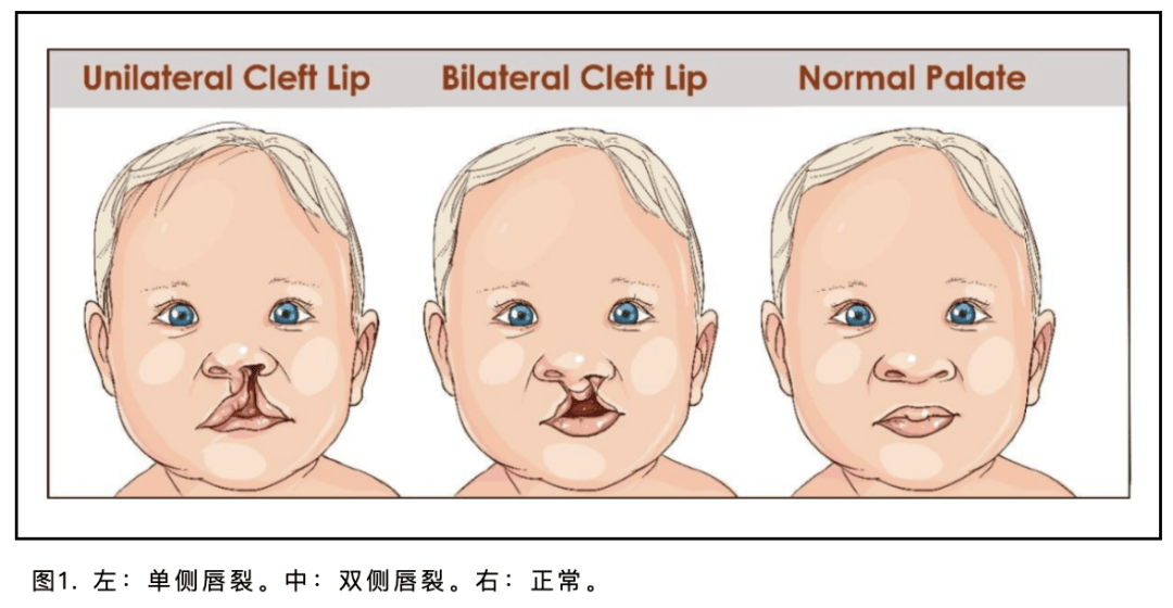 年增25万唇腭裂患儿每700名婴儿中就有一个“被天使吻过”的